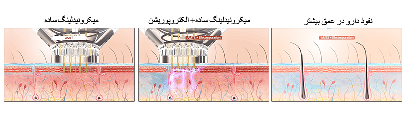 قیمت دستگاه میکرونیدلینگ برای مطب