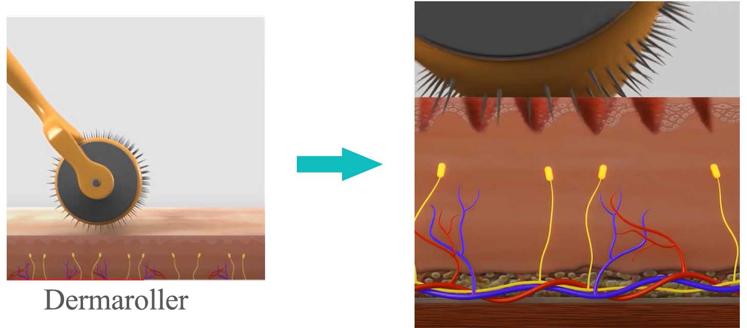 جوانسازی پوست با استفاده از درما رولر